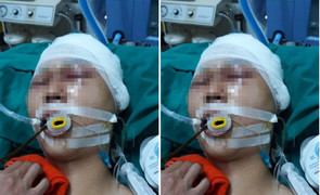 Nam sinh bị nhóm người đánh chấn thương sọ não ở Hà Nội