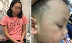 Đánh trẻ 3 tuổi ở Hà Nội bầm dập, tụ máu môi, cô giáo hoảng loạn, tìm cách tự tử