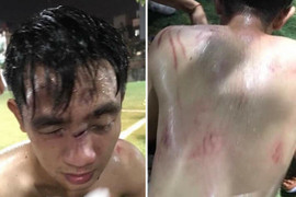 Va chạm khi tranh chấp bóng, nam thanh niên bị đội bạn đánh nhập viện ở Hà Nội