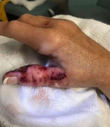 Người phụ nữ suýt mất tay do 'vi khuẩn ăn thịt người'