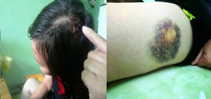 Nữ tài xế taxi bị 2 người đàn ông đánh rách đầu trong bệnh viện ở Huế