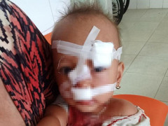Bố mẹ cãi nhau, con gái 2 tuổi rách mặt phải khâu 12 mũi