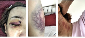 Người phụ nữ mang thai bị gã hàng xóm đánh rách mắt, đa chấn thương