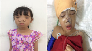 Phẫu thuật thành công cho bé gái bị loại dị tật hiếm gặp trên thế giới