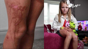 Dùng kem chống nắng, bé gái bỏng nặng như bị tạt axit