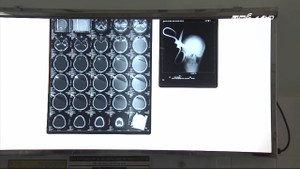 Đồng Nai: Bé trai 13 tuổi bị bố ném kéo xuyên sọ não
