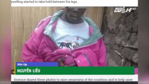 Không thể lấy vợ vì 'của quý' lớn gấp 10 lần bình thường