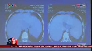 Bệnh viện Chợ Rẫy cứu sống bệnh nhân bị bệnh nguy hiểm hiếm gặp trên thế giới