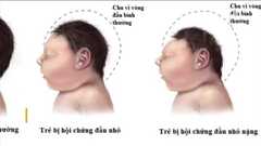 Việt Nam xuất hiện em bé đầu nhỏ đầu tiên nghi do Zika