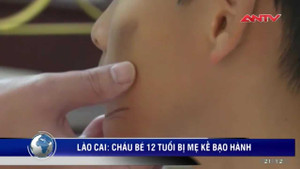 Phẫn nộ bé 12 tuổi bị mẹ kế, bố đẻ dùng chày đánh đập phải nhập viện