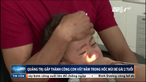 Gắp thành công con vắt dài 2,5cm trong hốc mũi bé 2 tuổi