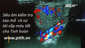 Video: Phẫu thuật cho thanh niên tự cắt lìa dương vật và tinh hoàn