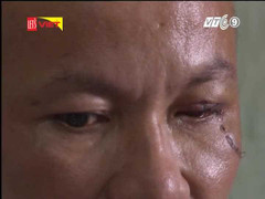 Sơ cứu đúng cách khi bị chấn thương mắt do hóa chất, vật nhọn đâm