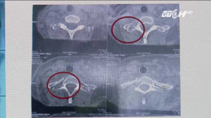 Bệnh hiếm khiến người mắc bị giảm chiều cao từ 1m62 xuống 1m55