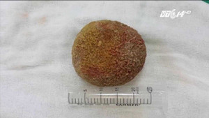 Nhịn tiểu nhiều, có viên sỏi nặng nửa cân trong bàng quang