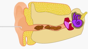 Lấy ráy tai bằng tăm bông nguy hiểm ra sao