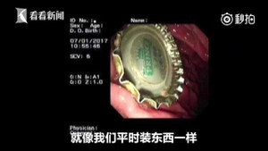 Trung Quốc: Bác sĩ dùng bao cao su lấy nắp chai bia ra khỏi dạ dày bệnh nhân