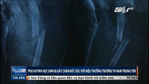 Học sinh gãy chân khi chơi trong sân trường: Hiệu trưởng bưng bít thông tin, gia đình bức xúc