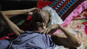 Video: Người đàn ông mắc bệnh lạ bị ăn hết khuôn mặt khiến ai cũng phải xót xa