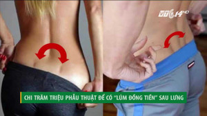 Đua nhau chi hàng trăm triệu phẫu thuật tạo 'lúm đồng tiền' ở... thắt lưng