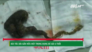 TP.HCM: Phẫu thuật lấy búi tóc dài gần nửa mét trong bụng bé gái 6 tuổi