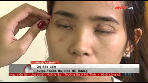 Cận cảnh hậu quả phẫu thuật thẩm mỹ chui, ai xem cũng khiếp sợ