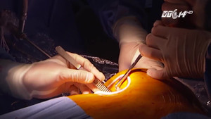 Bụng bệnh nhân quá nhiều mỡ, bác sỹ vất vả mổ nội soi