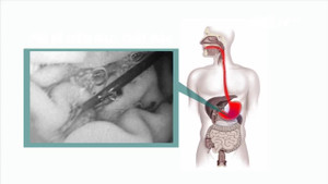 TP.HCM: Nuốt thanh sắt để trốn trại, học viên cai nghiện thủng dạ dày