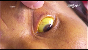 WHO báo động hơn 300 triệu người mang virus viêm gan