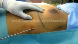 Đua nhau phẫu thuật thu nhỏ ngực ở Singapore