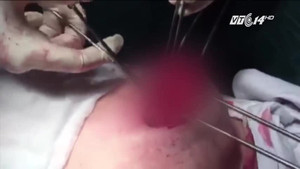 Hãi hùng 'chia tay' vòng 1 vì nâng ngực