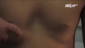 Lõm ngực bẩm sinh: Bệnh lạ ngày càng nhiều trẻ mắc