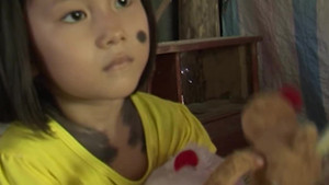 Xót xa bé gái 5 tuổi ở Cà Mau mọc đầy lông như người sói