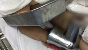 Xay thịt cho tiệm cơm, người phụ nữ mất cả bàn tay