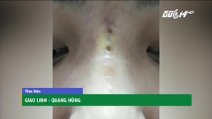 Nâng mũi bằng chỉ giá rẻ, nữ diễn viên bị thủng mũi
