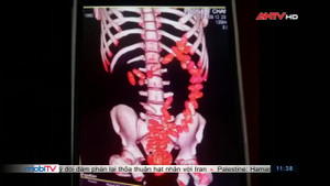 Người ngoại quốc nuốt ma túy vào bụng để qua cửa sân bay