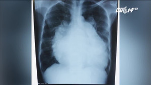 Tim phình to gấp đôi người thường, người phụ nữ phải ngủ ngồi 3 năm