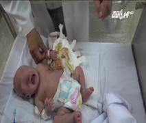 Video: Phẫu thuật cho bé sơ sinh mang khối bướu lớn gần bằng cơ thể