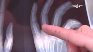 Cô giáo mầm non bị tố vụt gãy tay trẻ ở Nghệ An