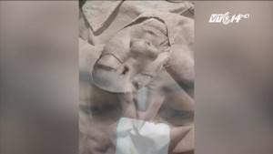 Nhìn hình ảnh này sẽ không còn ai dám tự ý đi phẫu thuật nâng mũi