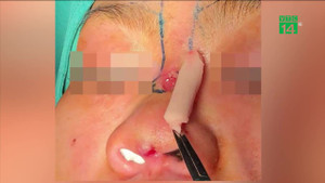 Đi nâng mũi, cô gái bị sụn silicon đâm thủng sống mũi