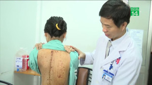 Phẫu thuật cột sống bị vẹo hơn 100°, thiếu nữ cao lên 7cm