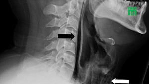 Cố nhịn hắt hơi, người đàn ông bị vỡ cổ họng