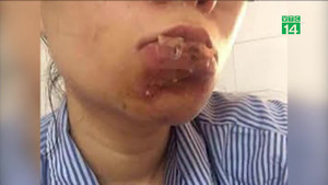 Làm đẹp đón Tết, coi chừng nát mặt, hỏng tóc, hoại tử da