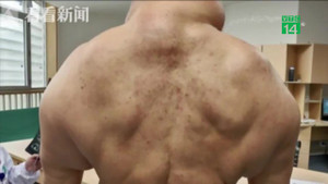 Clip: Mỗi ngày uống 1 lít rượu trong 25 năm, cơ thể biến dạng khủng khiếp