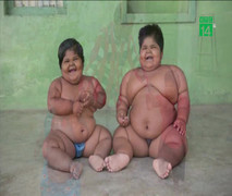 2 bé gái Ấn Độ phải cắt bớt dạ dày để giảm cân