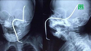 Chơi gần máy cắt cỏ, bé gái 8 tháng tuổi bị thanh sắt đâm xuyên má