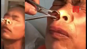 Clip: Rùng mình đỉa sống ngoe nguẩy trong mũi bệnh nhân