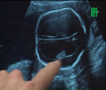 Clip: Đưa thai nhi 19 tuần tuổi ra ngoài phẫu thuật rồi trả lại bụng mẹ ngoạn mục