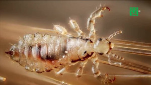 Gội đầu bằng thuốc trừ sâu để diệt chấy suýt mất mạng